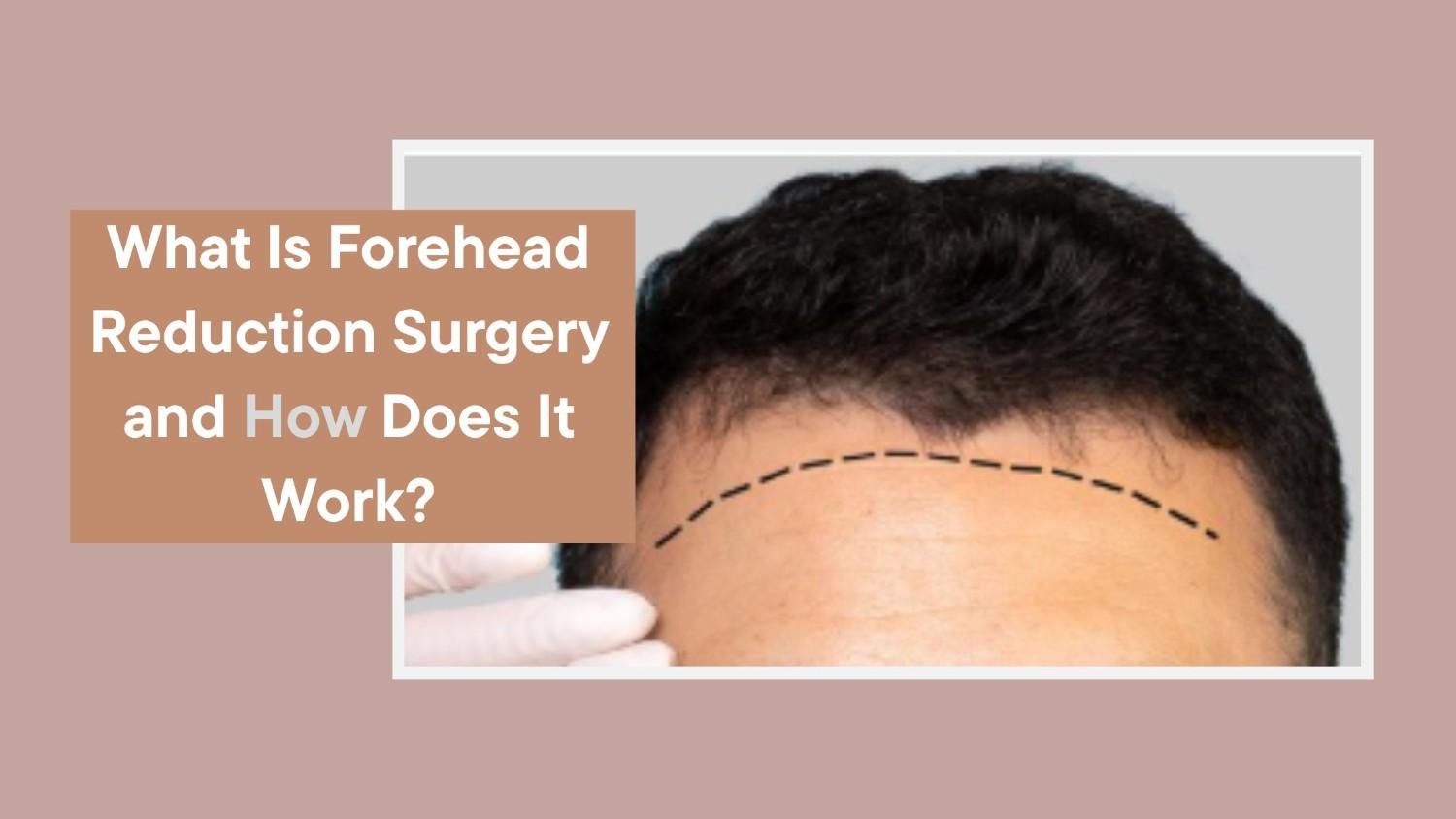 What Is Forehead Reduction Surgery and How Does It Work?