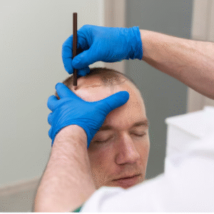Is a Hair Transplant Permanent? What You Need to Know